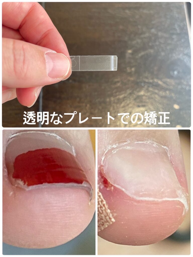 痛くない巻き爪プレート